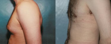 lgynecomastia1ll.jpg