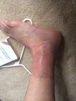 ankle3.jpeg