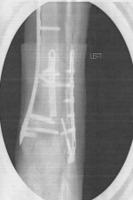 Xray of repair-1-1.png