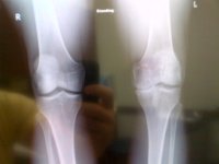 Knee Xray.jpg